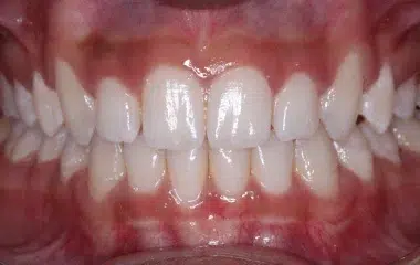 after bhatt wired orthodontics