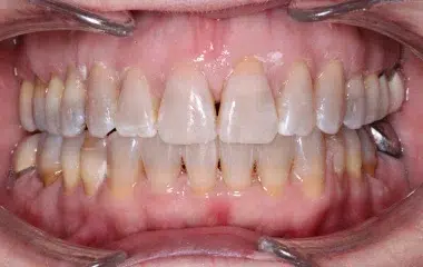 WIRED-ORTHODONTICS-AFTER-BRACES-PALACIOS