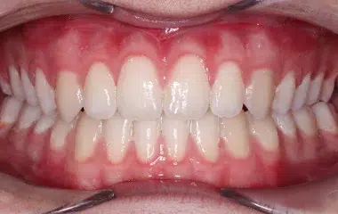 WIRED-ORTHODONTICS-AFTER-BRACES-PEREIRA