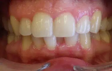 Before Biaz Wired orthodontics