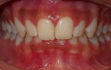 Before Bhatt Wired Orthodontics