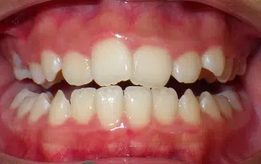 WIRED-ORTHODONTICS-BEFORE-BRACES-YANG