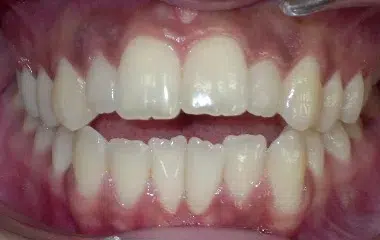 before ramirez wired orthodontics